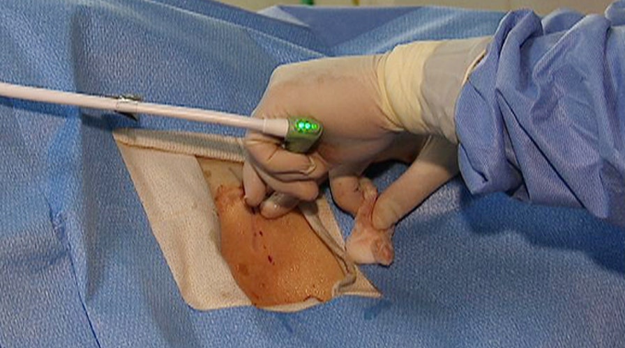 Curing kidney cancer without surgery